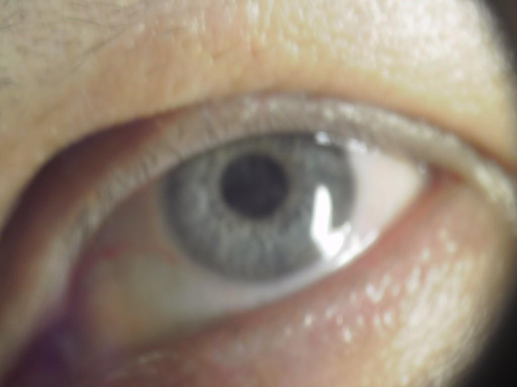 Резь в глазах при синдроме сухого глаза и попадании инородного тела. ощущение песка в глазах